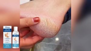 Foot Callus Remover Gel Hydrating Smooth Feet Skin Anti Drying Cracked Heel Repair Cream Soften Calluses Dead Skin Removal Gel