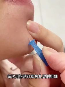 *Skin Friendly Disposable Needle 50pcs Blackhead Blemish Remover Tool for Acne Pimple-free Skin