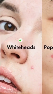 🔥Hot Sale🔥 Cute Style Colorful Star-Shaped Acne Patch Anti-Inflammatory Acne Waterproof Breathable Acne Patch Cover Acne Marks Gentle And Skin-Friendly Acne Hydrogel Patch Not Easy To Fall Off Promote Acne Healing Facial Concealer Patch