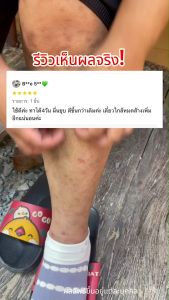 💥ครีม+สบู่ 290.-พญายอ พลูคาว จบทุกปัญหาเรื่องผิวหนัง สมุนไพรไทยแท้100% โปรจัดส่งฟรี