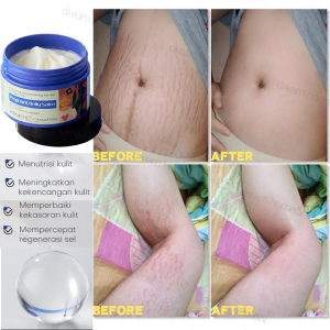 Stretch Mark Removal Cream Scar Cream Pregnancy Cream 120g Stretch Mark Cream Repair Cream Repairs Firming Skin Natural And Nourishing Ingredients Skincare For Pregnancy