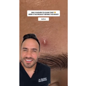 DOCTOR BABOR SOS Spot Treatment (15ml) | Pimple Rescue Clear Skin in 8 Hours