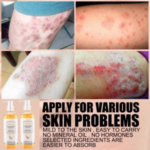 Psoriasis Body Lotion Gatal sabun mandi cair 260ml