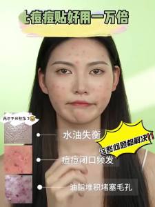 水杨酸精华液控油保湿补水祛痘抑痘痘印闭口粉刺黑头收缩毛孔面部Salicylic acid serum oil control moisturizing hydration acne suppression acne scar suppression acne closure blackheads pore shrinking face