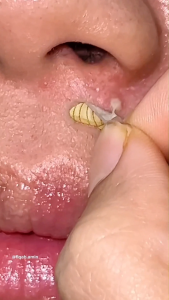 SimplyHeal Day & Night Premium Hydrocolloid Acne Patch (Hologram Series)