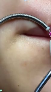 Facial Hair Removal Performance Premium Epilator Hair Removal Tool for Chin Cheek Mustache Upper Lip 脸部除毛器