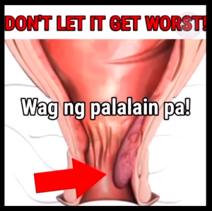 Top Seller HERBAL HEMORRHOID MIRACLE OINTMENT CREAM | 100% Original Authentic Hemorrhoid Cream Pain Relief with 100% Natural Herbal Extracts Formula | External & Internal Hemorrhoid Treatment for Itching Swelling Bleeding and Maximum Pain Relief.