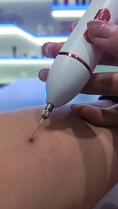 ปากกาเลเซอร์ลบจุดด่างดำ เครื่องมือความงามลบจุดด่างดำ เครื่องมือลบจุดด่างดำแบบใช้ไฟฟ้าที่บ้าน ปากกาลบไฝอัลตราโซนิกแบบพกพา