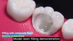 A1 A2 A3 General Purpose Dental Light Curing Material for Fillings and Restorations