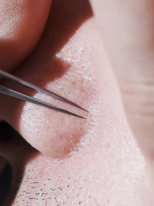 Cell clamp Stainless steel Remove blackhead tweezers needle for removing acne fat granules comedones Tahan lama