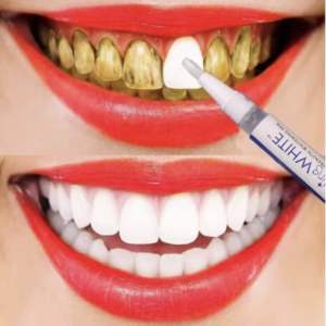 Terlaris Dazzling White Gel Pemutih Gigi - Pemutih gigi kuning permanen - Instant Teeth Whitening Gel Pen Veneer Artis   Langsung Putih Bersih