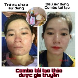 CHÍNH HÃNG -Combo Kem Face Tái Tạo Da Da Truyền Giúp Da Căng Bóng Mịn Màng Sạch Nám Mụn Tàn Nhang Lọ 30gr