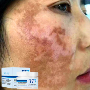 Freckle Cream 377 Krim pemutih dan noda Menghilangkan chloasma/bintik-bintik penuaan/bintik-bintik matahari Melembabkan