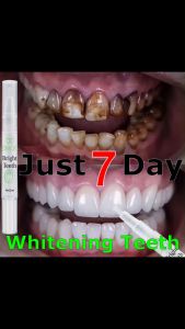 LYDIMOON Teeth Whitening Gel Pen Remove Stains Remove Yellow Teeth Teeth Whitener Cleaning Oral Care Remove Plaque Bright Teeth