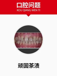 NIULAODIE | Bộ Dụng Cụ Làm Sạch Răng