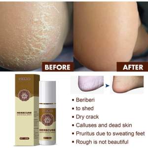 SOUTH MOON HERBCURE ANTI-FUNGAL SPRAY penghalus tapak kaki tumit kaki kulit kaki cantikkan kulit merekah kering pecah mengelupas