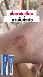 Japanese scar remover cream original for old scars stretch mark remover acne scar remover peklat remover cream original peklat remover for old scars legs pantanggal ng peklat scars remover for old scars keloid scar remover 20g