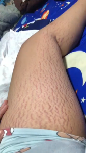 【100% ORI】krim stretch mark Stretch mark cream Penghilang stretch mark 120g Krim Penghilang Strechmark Aman untuk Ibu Hamil dan Menyusui