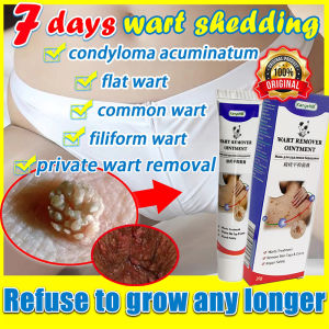 hard skih wart softener Foot Corn Warts cream 20g wart corn warts calluses footcorn plaste meat thorn antibacterial 克疣膏 鸡眼膏