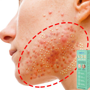 Krim Anti Jerawat & Salep Jerawat 20g: Perawatan Kulit Berjerawat Efektif