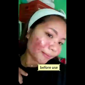 Serum Perawatan Jerawat 20ml: Menghilangkan komedo hitam dan putih mengecilkan pori-pori memutihkan dan melawan penuaan mengurangi kerutan dan mengontrol produksi minyak. Mengandung ekstrak bio-sulfur dan centella asiatica.