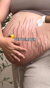 Ciara Stretch Mark Treatment & Skin Elasticity Booster Cream Stretchmarks Krim Selulit Ibu Hamil