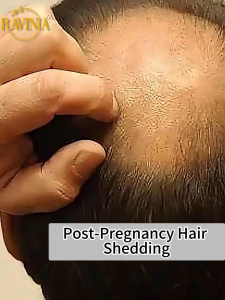 RAVINIA Hair Growth Spray 60ml Anti Hair Loss Healthy Strong Hair Care Repair Scalp