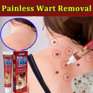 skin tag remover warts removal cream Foot Warts Hand Warts 20g genital wart Antibacterial Corn Removal Natural Herbs