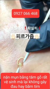 1 gói có 100 cây Tăm bông gỗ dùng để nặn mụn cục kỳ tiện lợi vệ sinh mà lại không gây đau hay bầm tím