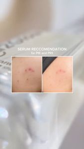 Glad2Glow Yuja Symwhite 377 Dark Spot Serum 17ml Whitening & Fade Dark Spot Brightening Serum