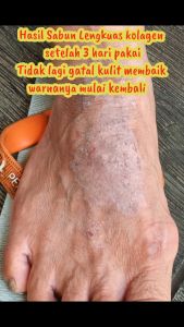 Sabun ROO Lengkuas Kolagen: Solusi Panu, Kadas, Gatal, Eksim, Jamur & Bakteri