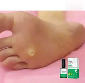 Serum Loại Bỏ Mụn Cơm Bắp Loại Bỏ Da Tags