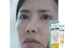 Krim Penghilang Flek Hitam & Bekas Jerawat: 3 Hari Efektif