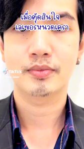 [E-Voucher] APEX เลเซอร์กำจัด หนวด เครา คาง ผู้ชาย เลเซอร์ 3พลังงาน ลงลึกถึงราก เส้นขน บางลง เห็นผล