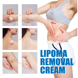 Lipoma Removal Cream Remove Tumor Skin Swelling Ointment Original Herbal Pain Relief Cream Body Hard Block Remove Plaster脂肪瘤膏50g