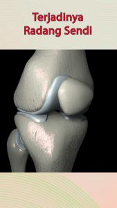 Obat Sakit Sendi dan Lutut Nyeri Sendi Pengapuran Tulang Osteoporosis Joint Nature