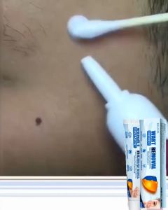 Fast+Painless⚡️SouthMoon Warts Remover Original Cream 20g Available for all skin types warts and skin tags remover wartz remover Warts Remover Original Skin Kulugo Remover Skin Growth kulogo remover Mole remover wart remover cream ointment