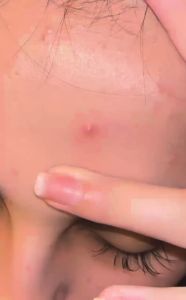 Isntree Onion Newpair Spot Patch SkinFit | Basic 12mmx15ea patches by SkinCaring18 SK