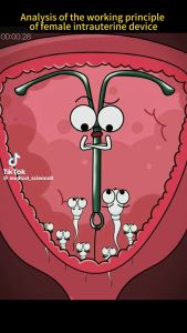 IUCD SMB Cu375 Standard Sterile