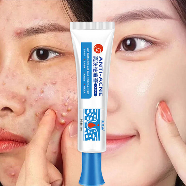 GL.25g Pimple Remover Cream Acne Removal Scar Marks Cream Acne Treatment Skin Cream Effective Anti-acne