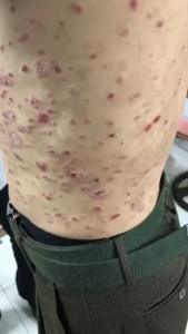 Kem Bôi Da Nhật Bản Thảo Dược Hỗ Trợ Giảm Ngứa Dị Ứng Viêm Da Nổi Mẩn Đỏ An Toàn Dịu Nhẹ Cho Mọi Loại Da 15G Chính Hãng