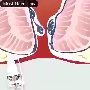 EELHOE Obat Wasir Obat Hemoroid Semprotan Spray Wasir Obat Ambeien 30ml Obat Ambeien Tipe Campuran Tipe Bola