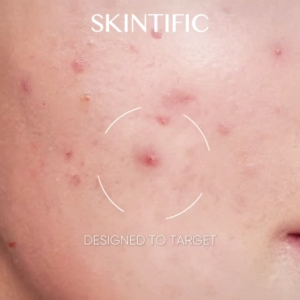 SKINTIFIC Anti Acne Set 3X Acid Gel Moisturizer 30g + 2% Salicylic Acid Anti-Acne Serum 20ml Control Excess Oil Minimize Breakout Calm Acne Redness Soothe Bumpy Skin Facial Skincare Kit