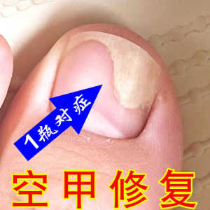 Nail Bed Separation Repair Nutritional Liquid Vertical Stripes Layered Peeling Treatment for Hollow Nail And Damaged Nails