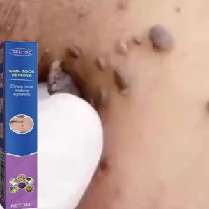 Skin Tag Mole Corn Wart Removal Pen Obat Kutil Mata Calluse Remover Buang Tahi Lalat Ketuat Warts
