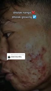 SR12 Sabun Bulus Untuk Mengurangi Permasalahan Kulit Gatal 6gr VA044