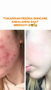 EMEDICAL PAKET ACNE tanpa SERUM beruntusan & jerawat