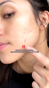 MEDI-PEEL Melanon X CreamDark Spots Pigmentation| Freckles Niacinamide Whitening Cream |Double Care for Freckles30ml
