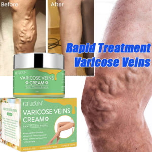 Varicose Vein Treatment Cream Remover Effective Original SEFUDUN Varicose Veins 50g Spider Vein Pain Varicosity Effective Cure Vasculitis Promote Blood Circulation and Relieve Swelling of Veins Varicose Vein Cream