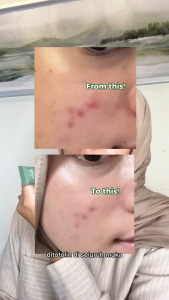 Reglow Acne Spot Gel Double Action Bebas Kusam dan Bekas Noda Hitam